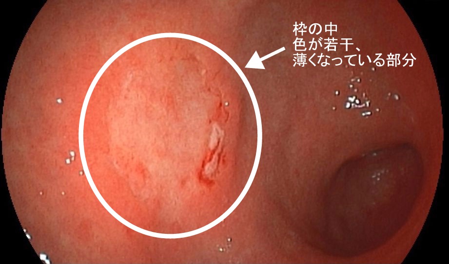 胃がんの内視鏡画像